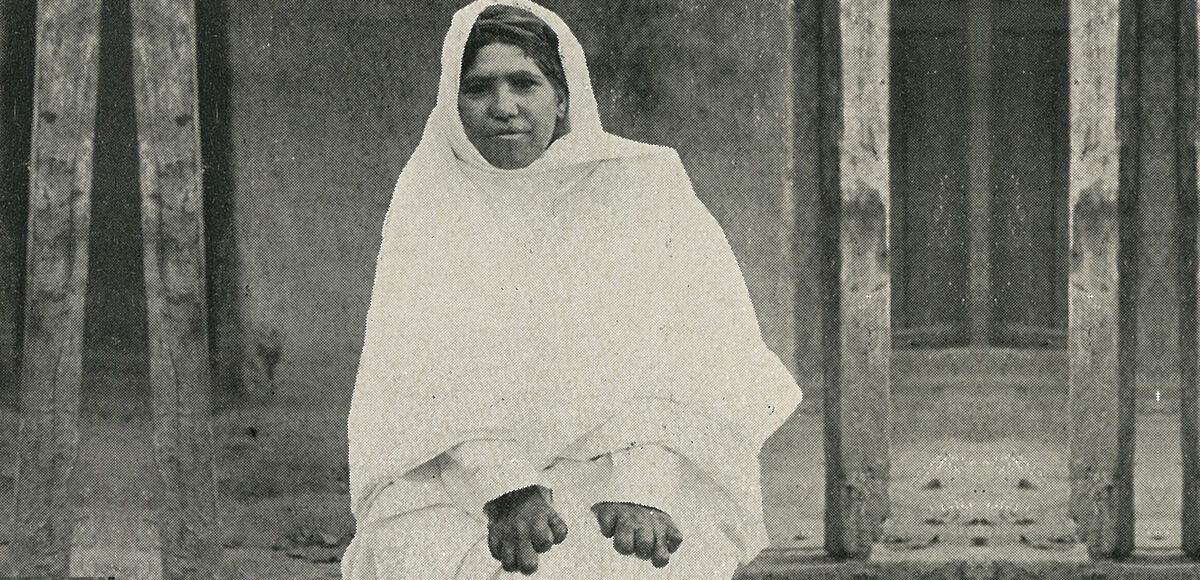 Sandhlu, a woman affected by leprosy in Chamba, India (circa 1912)